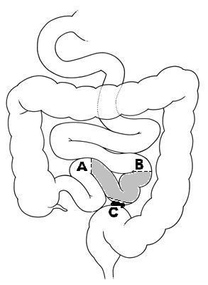 intestinal blockage